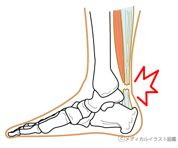 アキレス腱断裂