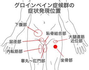 グロインペイン症候群の症状の位置